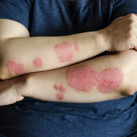 Understanding Psoriasis: Causes, Symptoms, and Its Impact on the Body